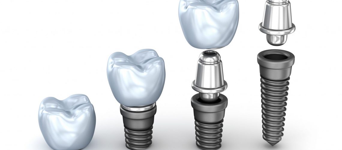 Feature Image 3 - Dental Implants