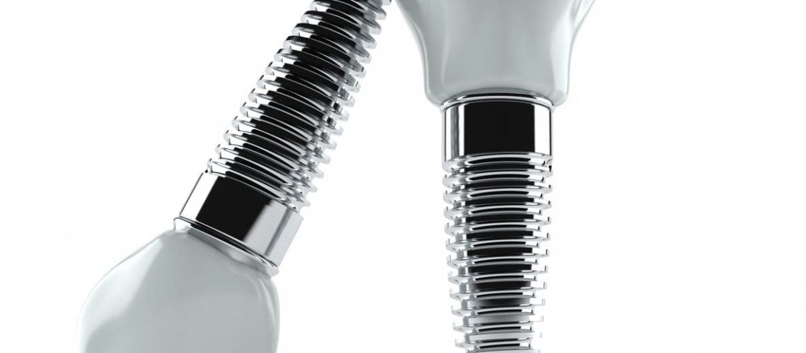 Who does dental implants near me? - Graceful Smiles Dentistry